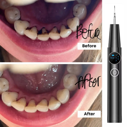 TartarOff Pro before and after - Black