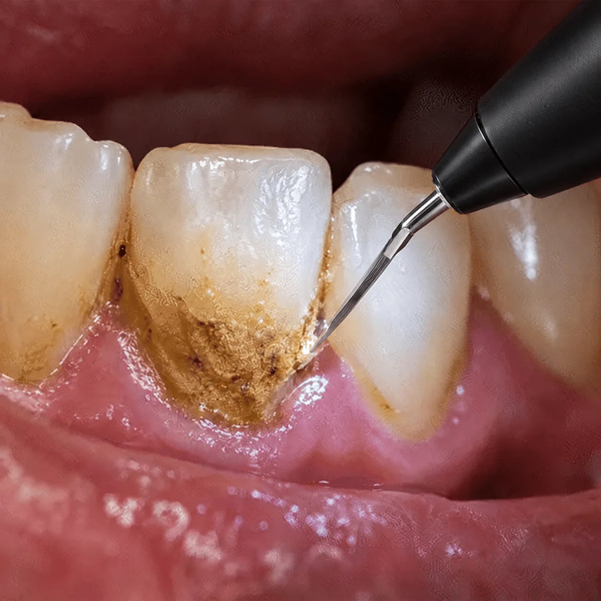 Ultrasonic tip removing tartar at the gumline